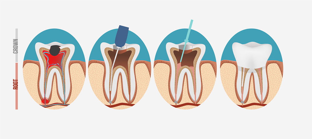 歯を残すための大切な治療「根管治療」