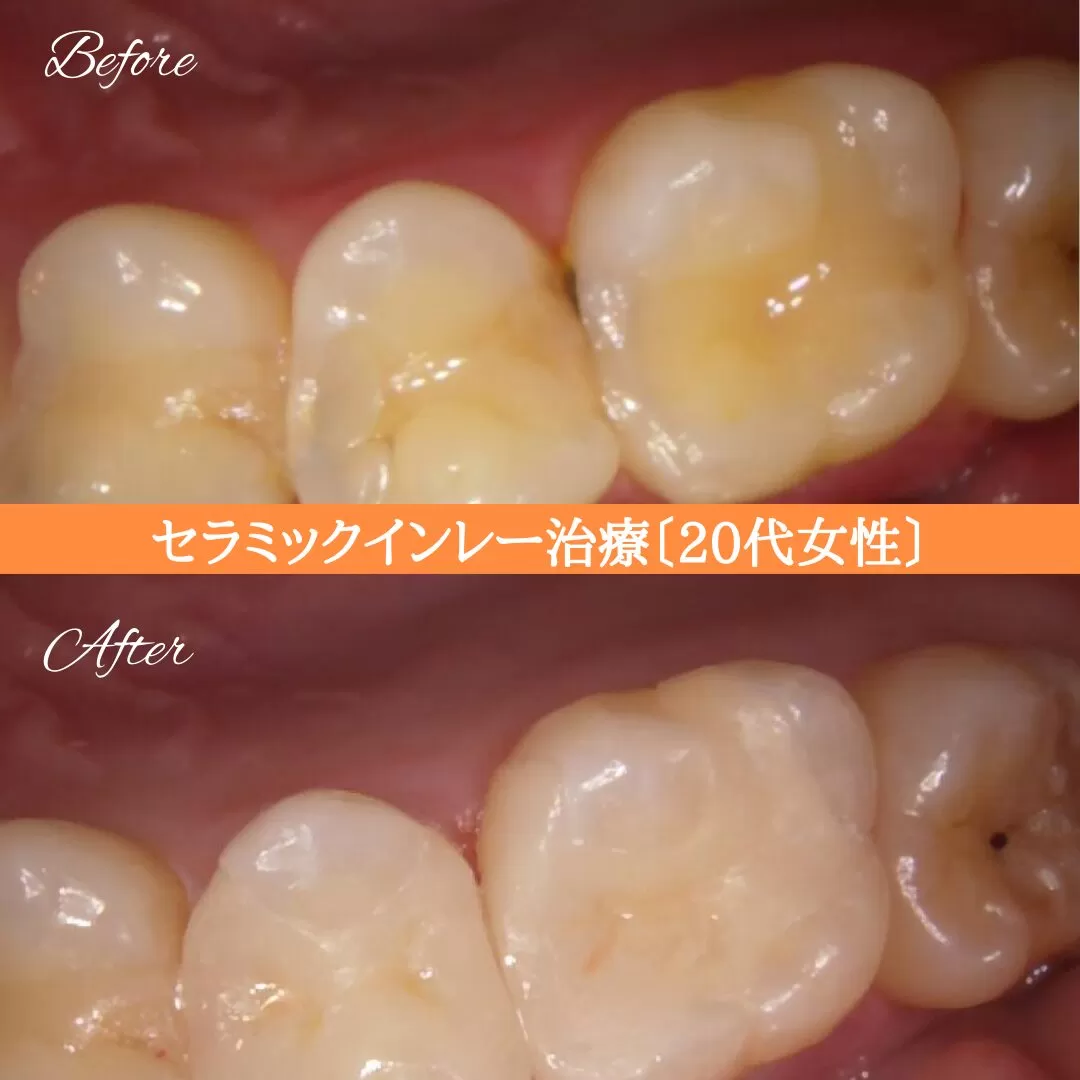 症例⑤ セラミックインレー治療 20代女性 img