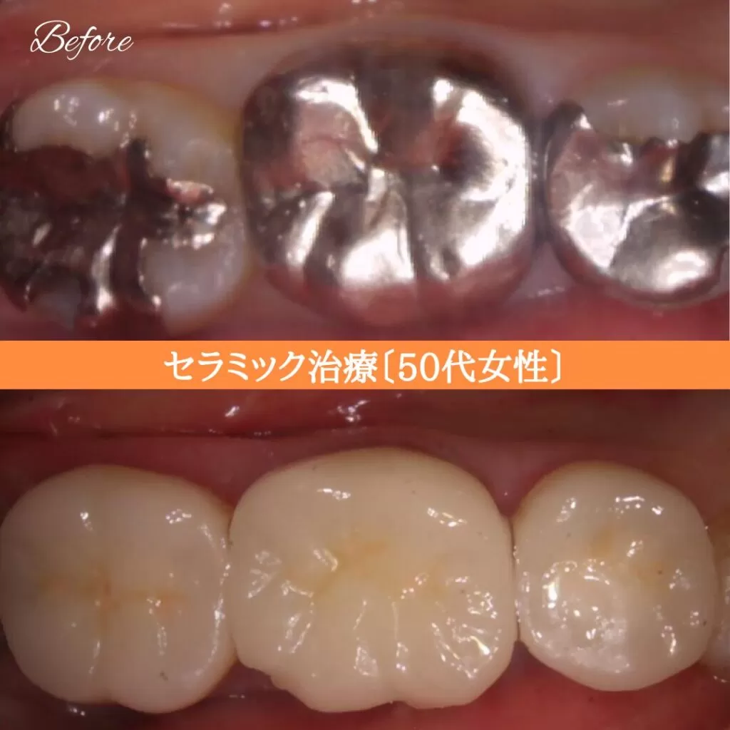 症例⑥ セラミック治療 50代女性 img