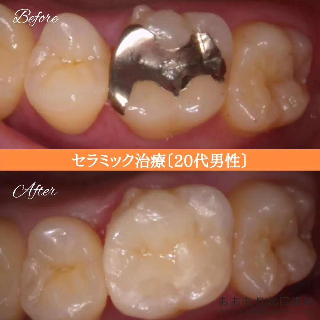 症例⑨ セラミックインレー治療 20代男性 img