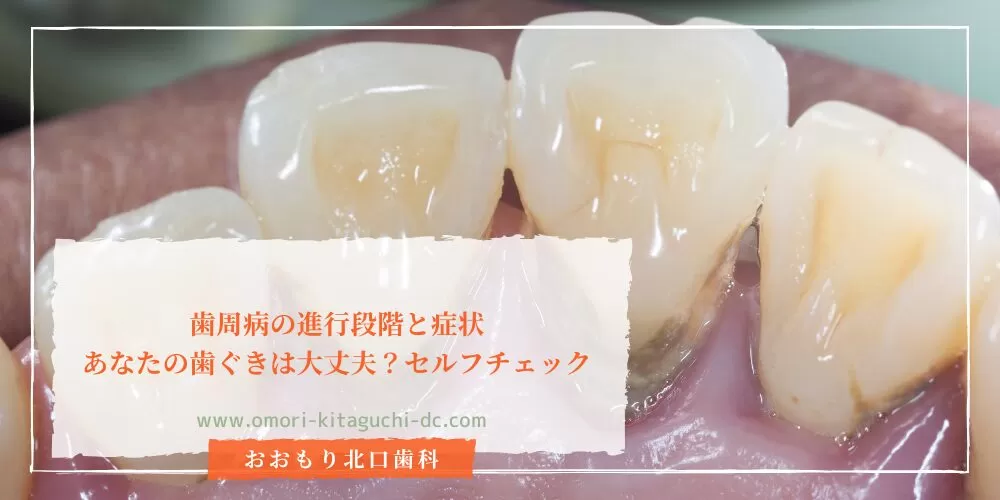 歯周病の進行段階と症状｜あなたの歯ぐきは大丈夫？セルフチェック