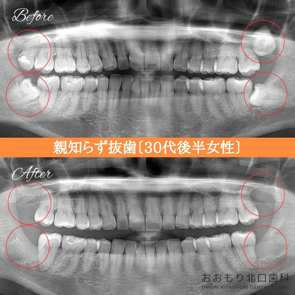 症例紹介㉙親知らず抜歯(30代後半女性) img