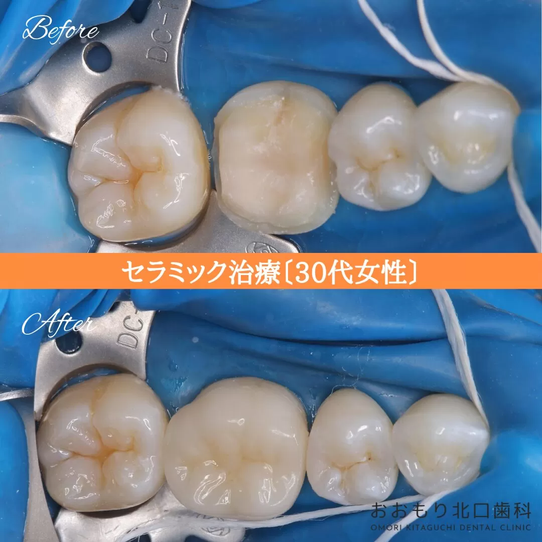 症例⑭ セラミック治療 30代女性 img