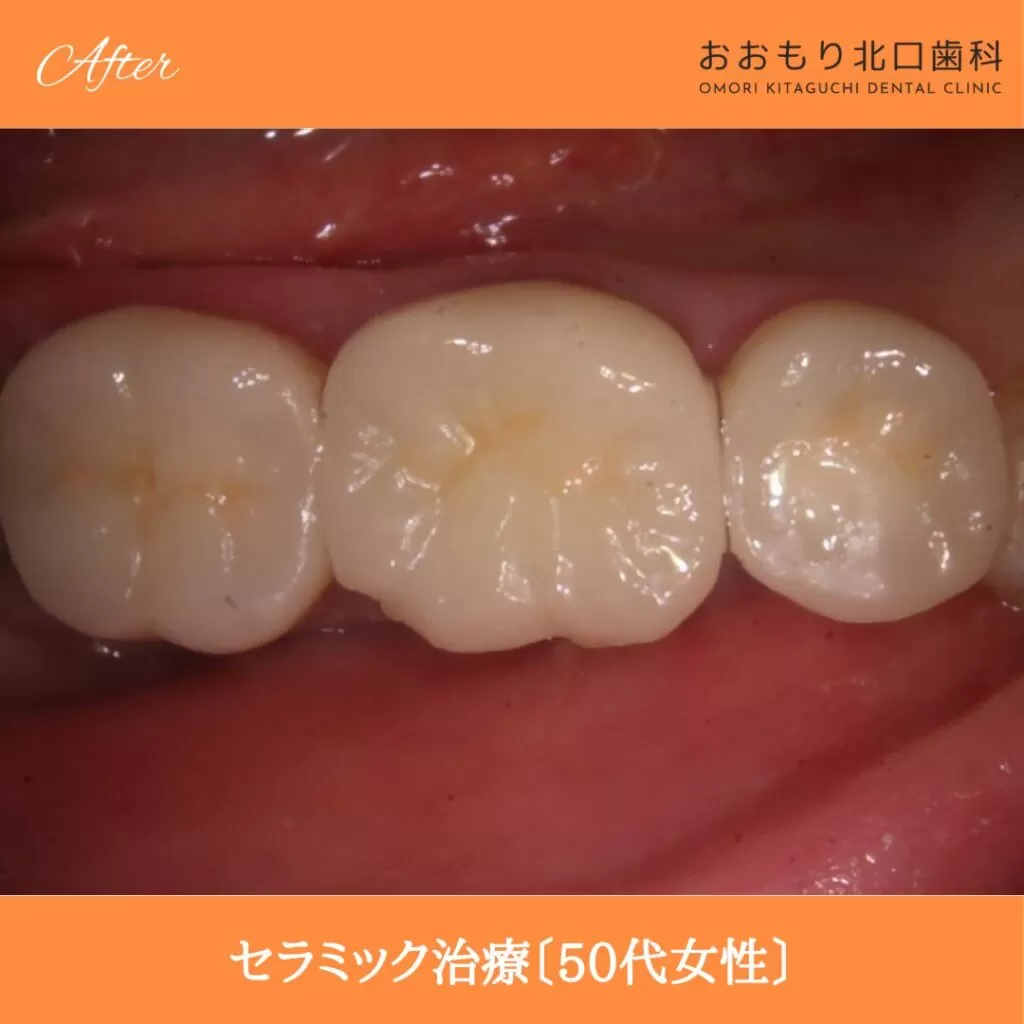 症例⑥ セラミック治療 50代女性 img