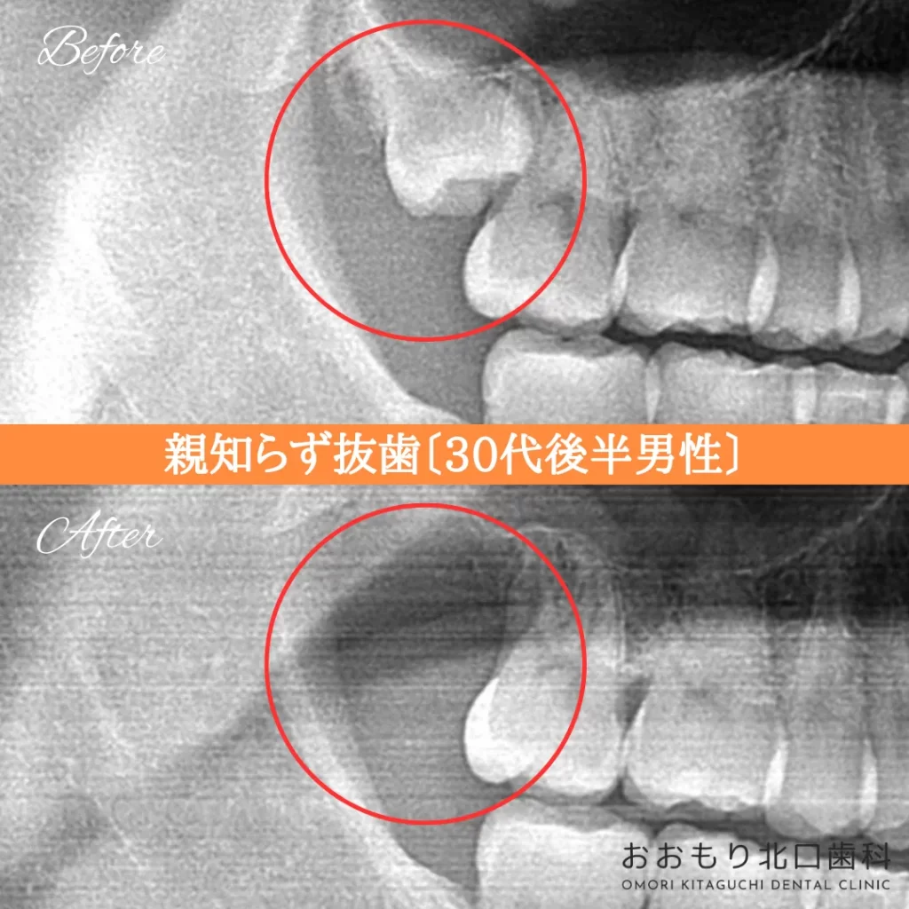 症例紹介㉚親知らず抜歯(30代後半男性) img