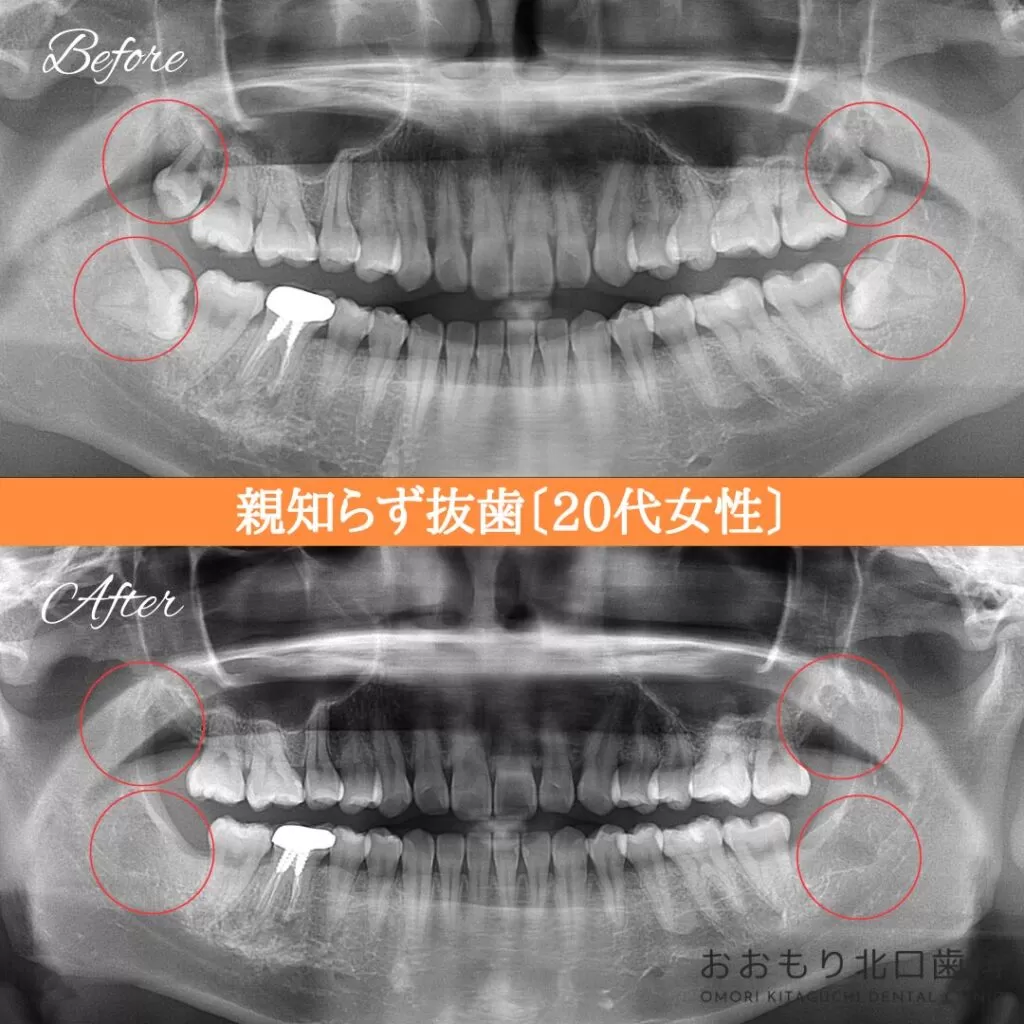 症例紹介㊹親知らず抜歯(20代女性) img