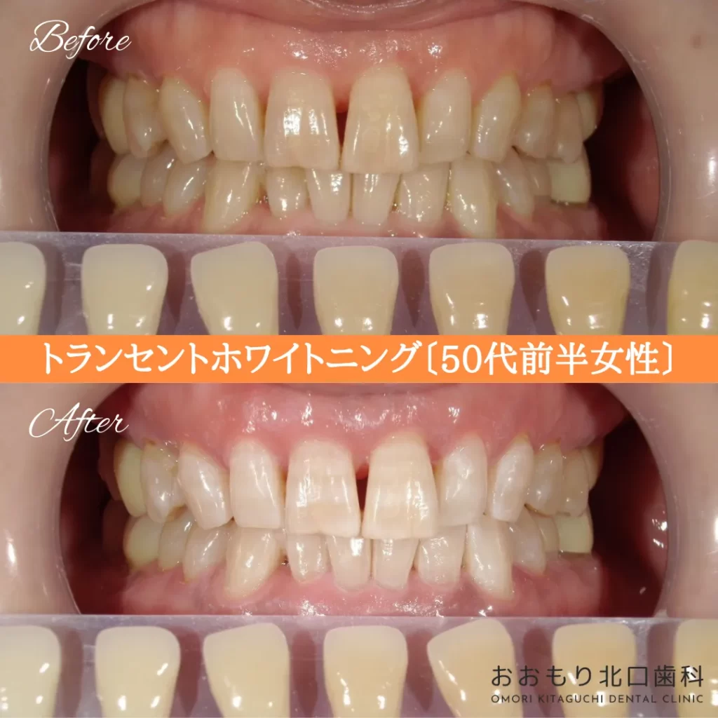 症例紹介㊺トランセントホワイトニング(50代前半女性) img