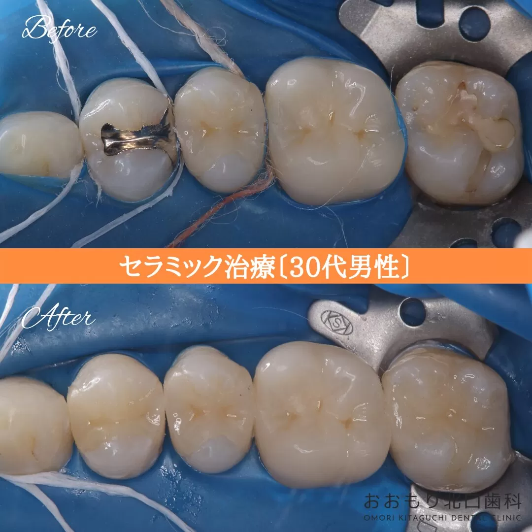 症例⑱ セラミックインレー治療 30代男性 img