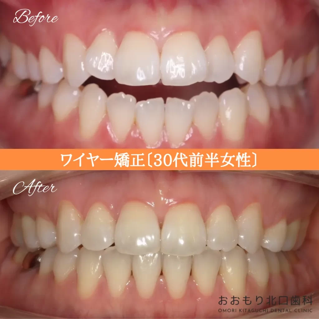 症例紹介⑦ワイヤー矯正(30代前半女性) img