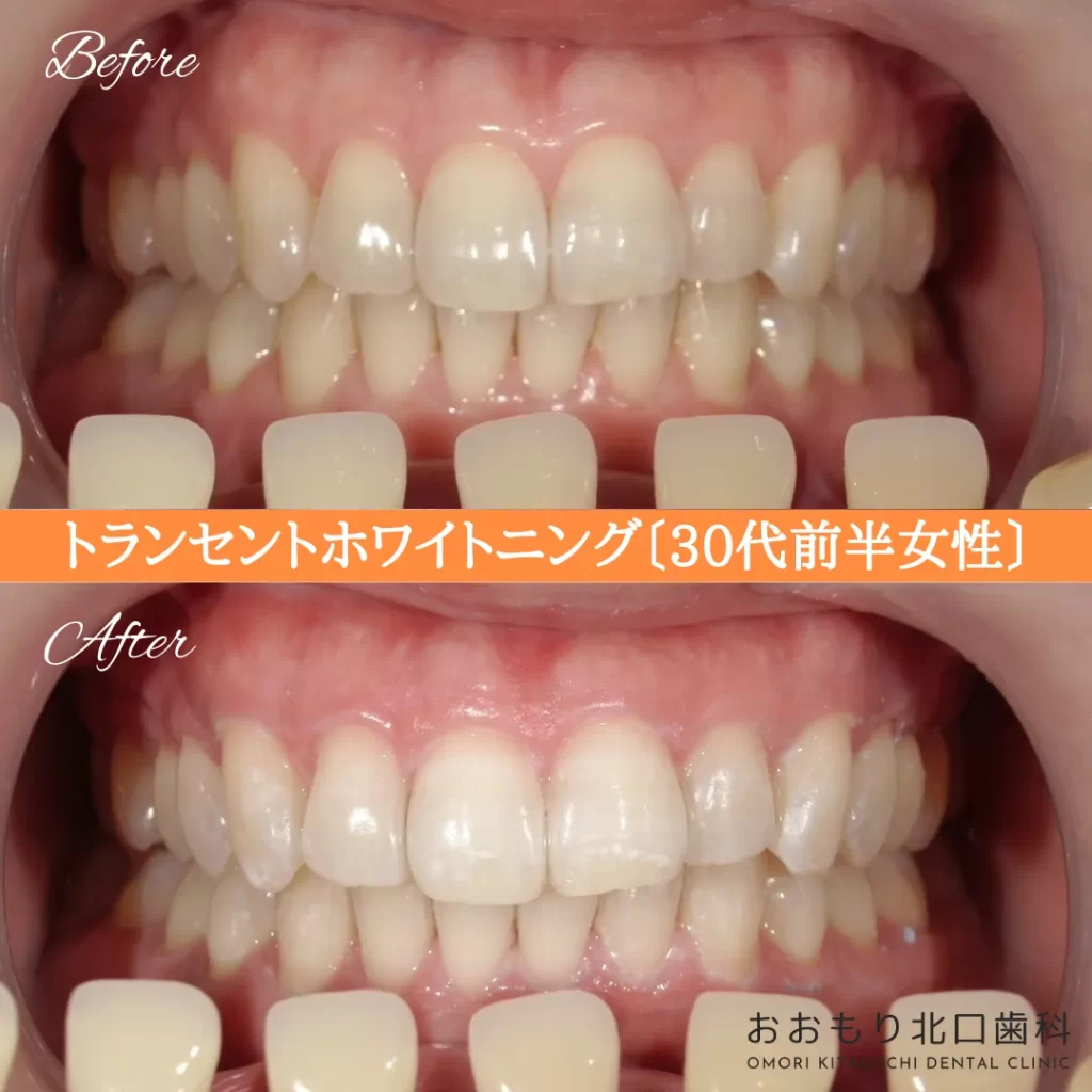 症例紹介67トランセントホワイトニング(30代前半女性) img
