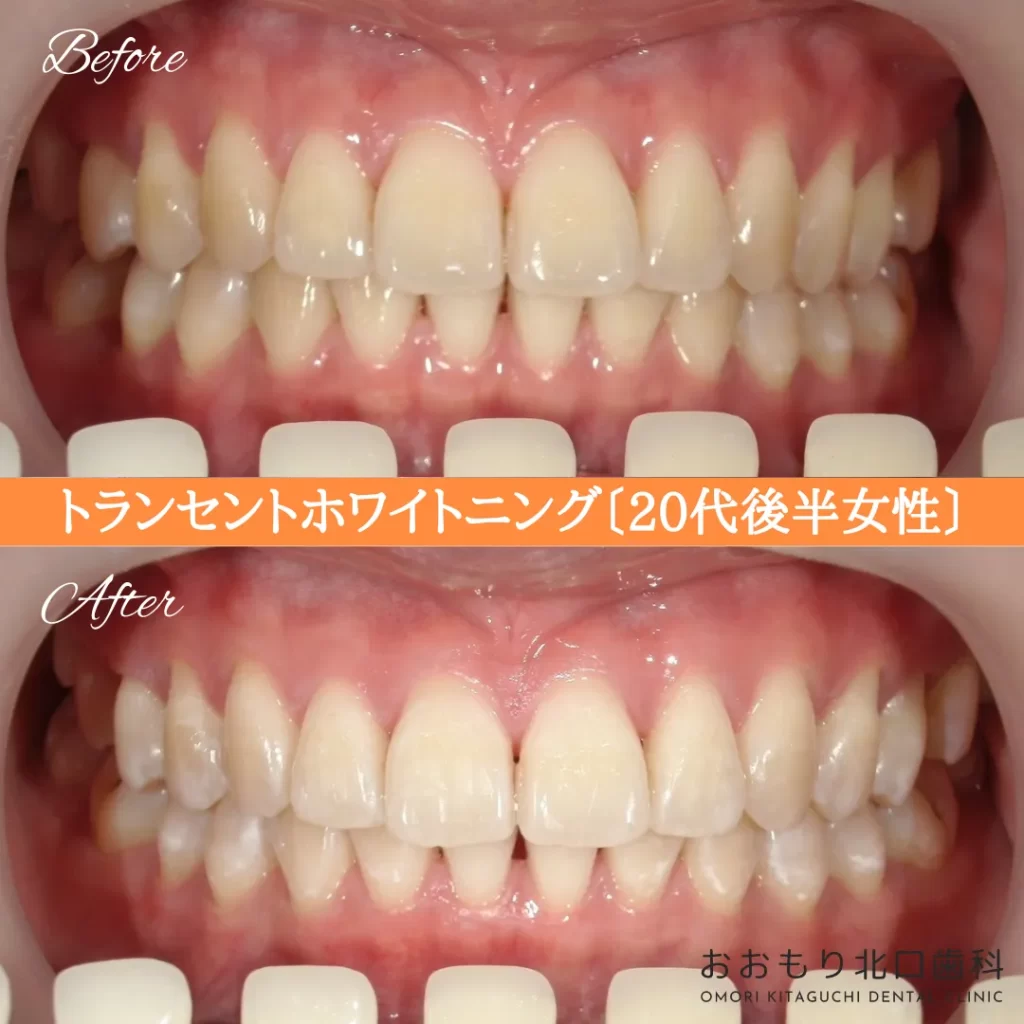 症例紹介68トランセントホワイトニング(20代後半女性) img