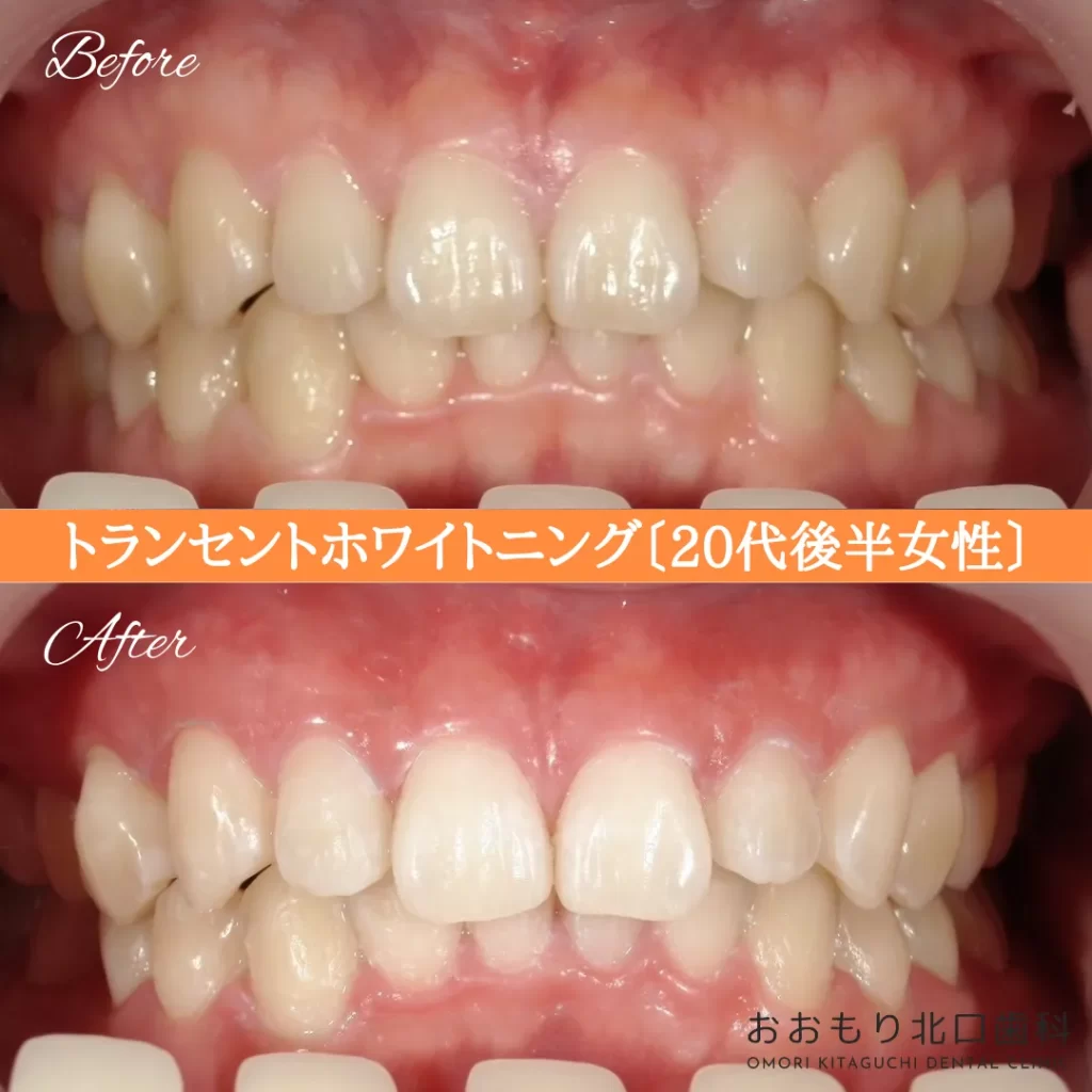 症例紹介69トランセントホワイトニング(20代後半女性) img