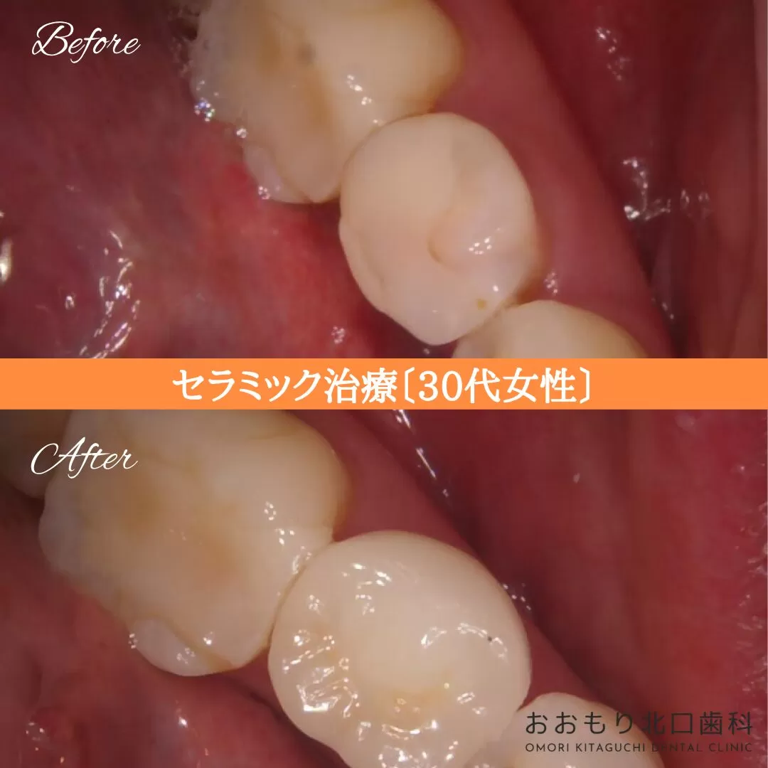 症例⑦ セラミック治療 30代女性 img