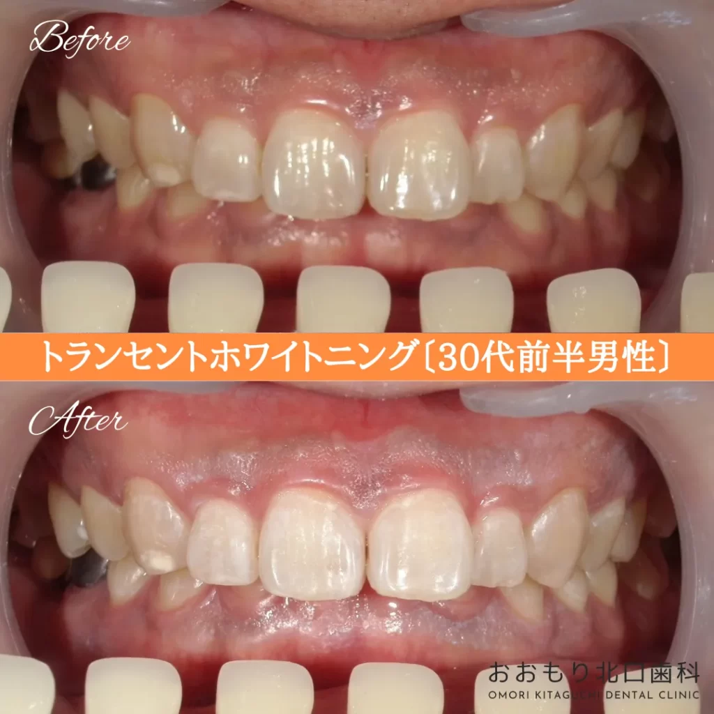症例紹介70トランセントホワイトニング(30代前半男性) img