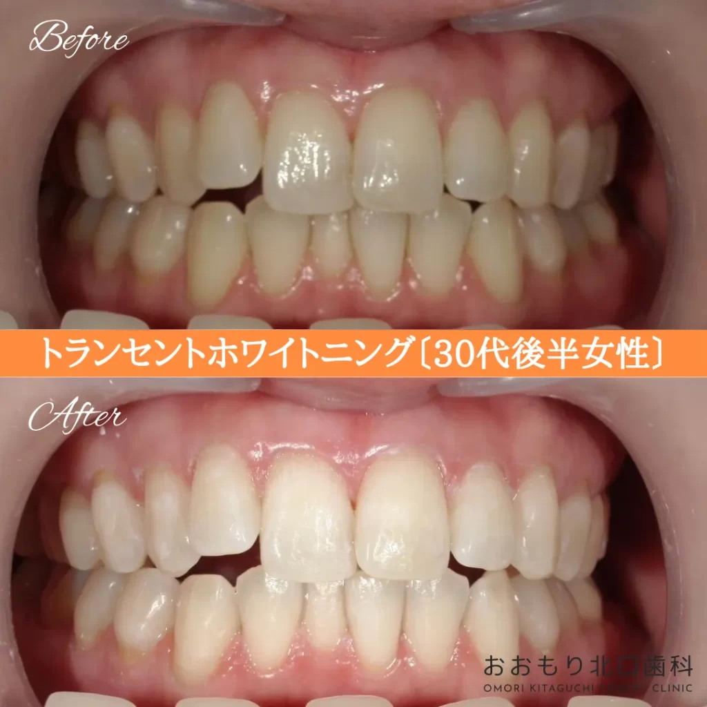 症例紹介72トランセントホワイトニング(30代後半女性) img