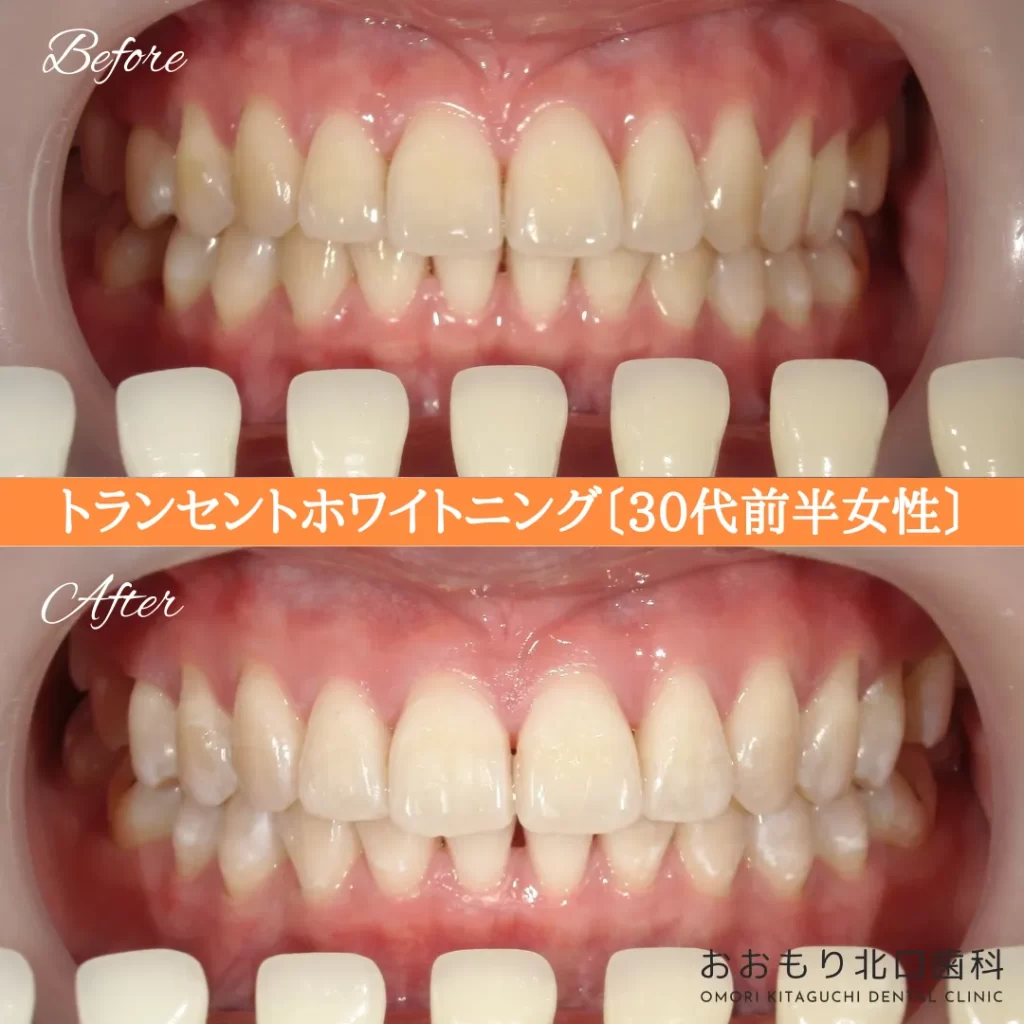 症例紹介75トランセントホワイトニング(30代前半女性) img