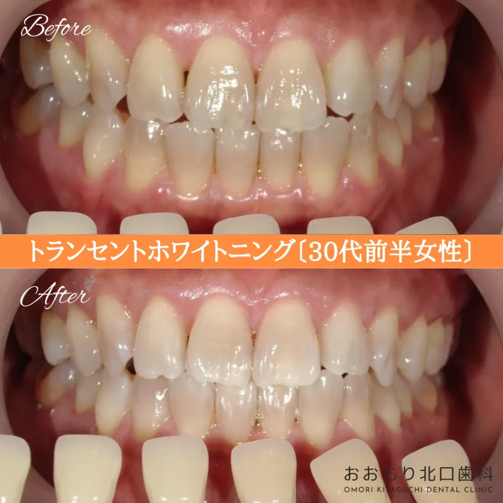 症例紹介78トランセントホワイトニング(30代前半女性) img
