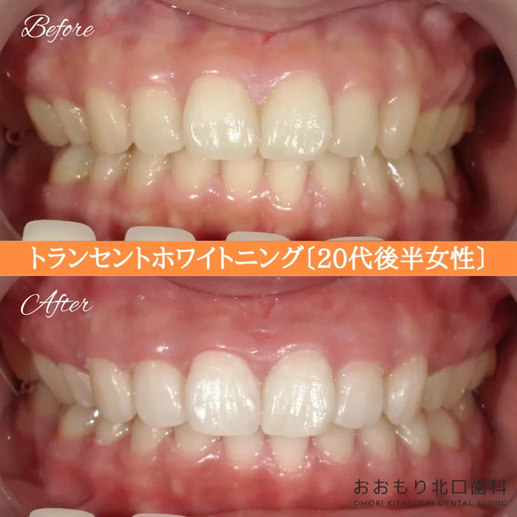 症例紹介80トランセントホワイトニング(20代後半女性) img
