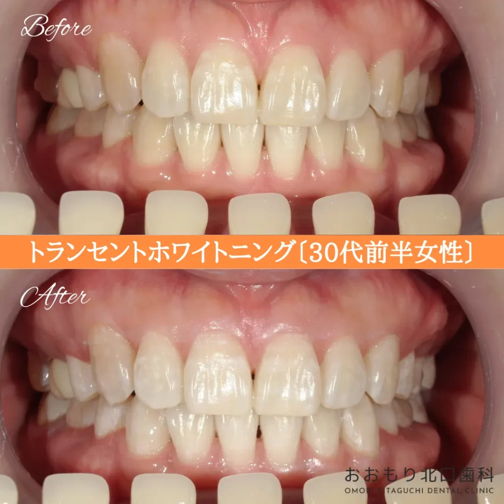 症例紹介82トランセントホワイトニング(30代前半女性) img