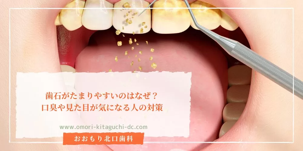 歯石がたまりやすいのはなぜ？口臭や見た目が気になる人の対策