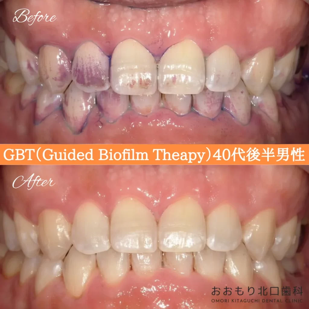 症例紹介⑨GBT(Guided Biofilm Therapy)40代後半男性 img