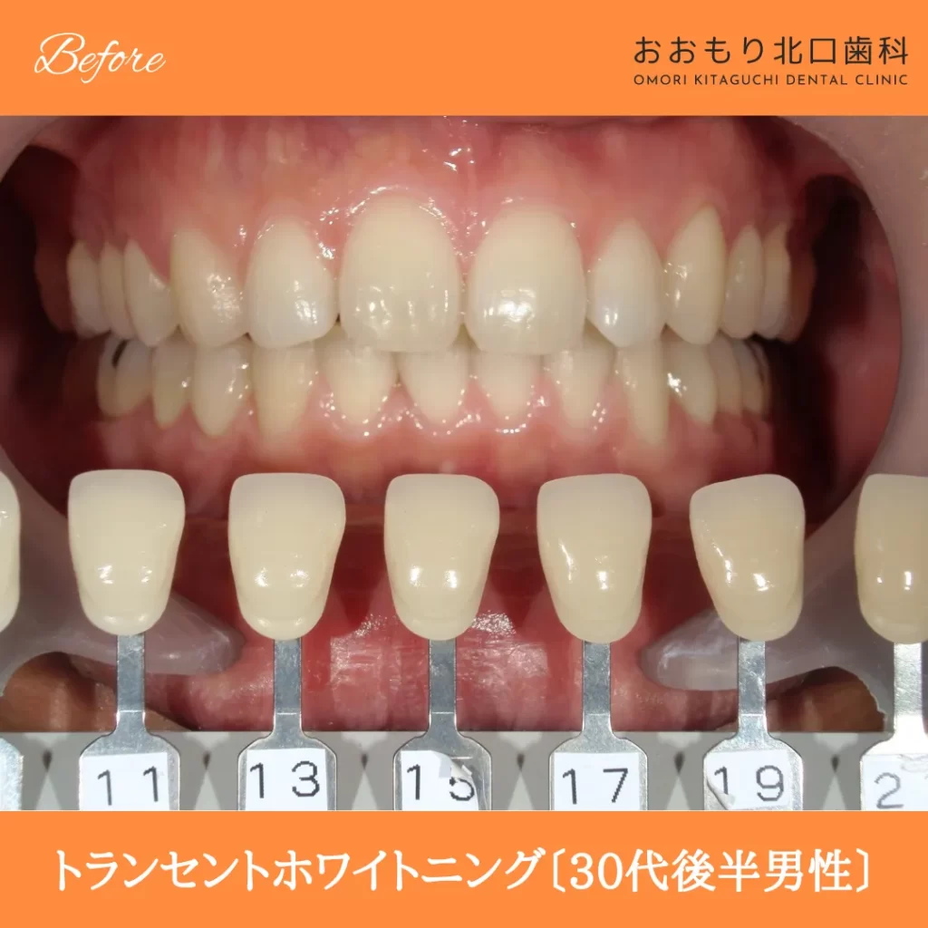 症例紹介84トランセントホワイトニング(30代後半男性) img