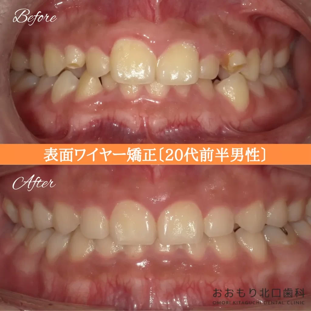 症例紹介⑨表側ワイヤー矯正(20代前半男性) img