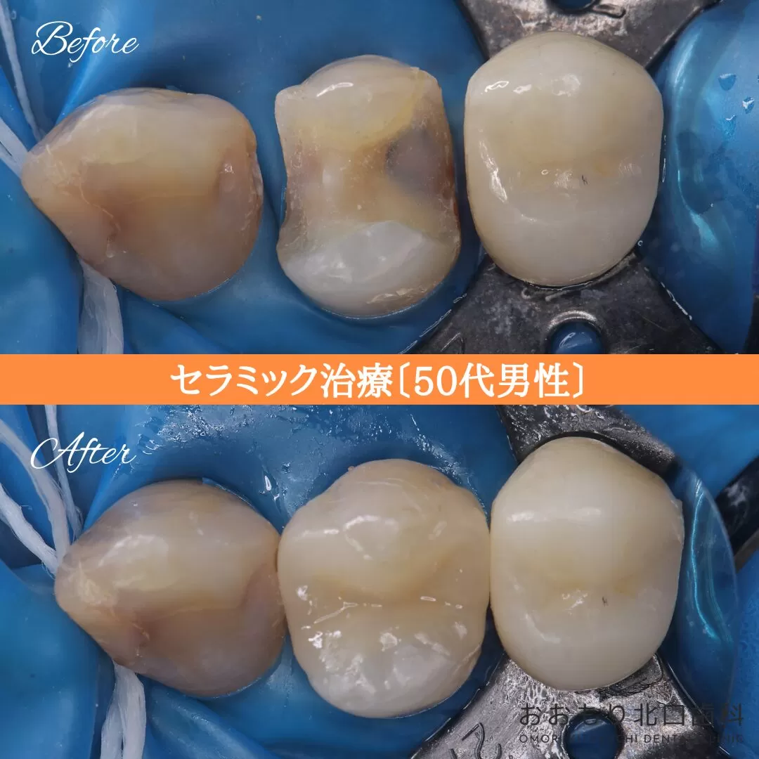 症例⑮ セラミックインレー治療 50代男性 img