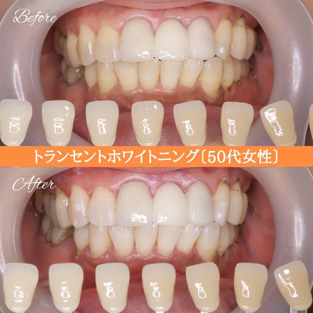 症例紹介96トランセントホワイトニング(50代女性) img