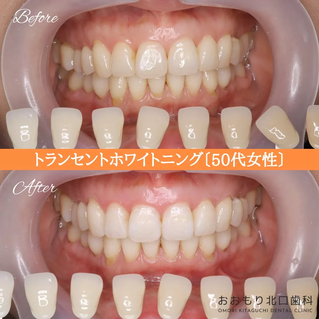 症例紹介97トランセントホワイトニング(50代女性) img