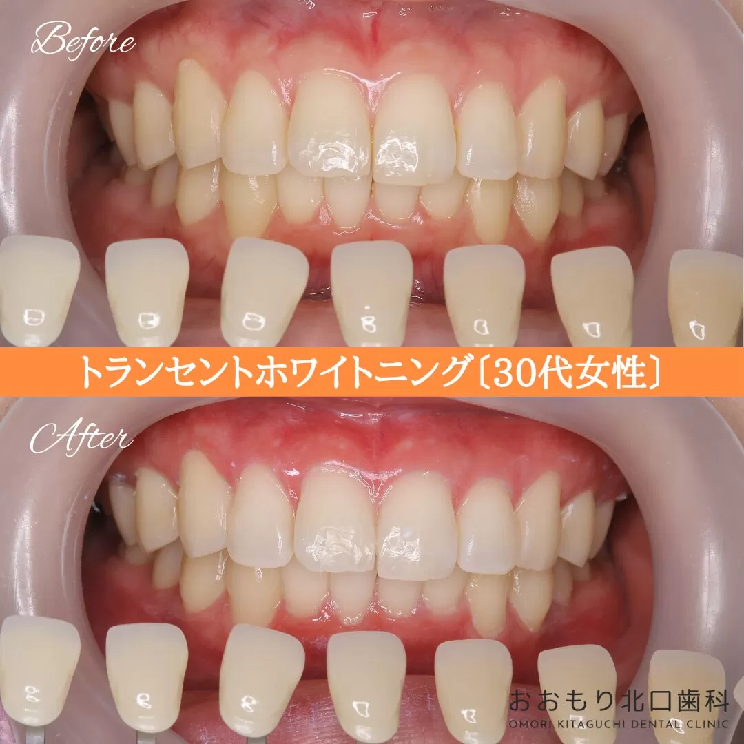 症例紹介98トランセントホワイトニング(30代女性) img
