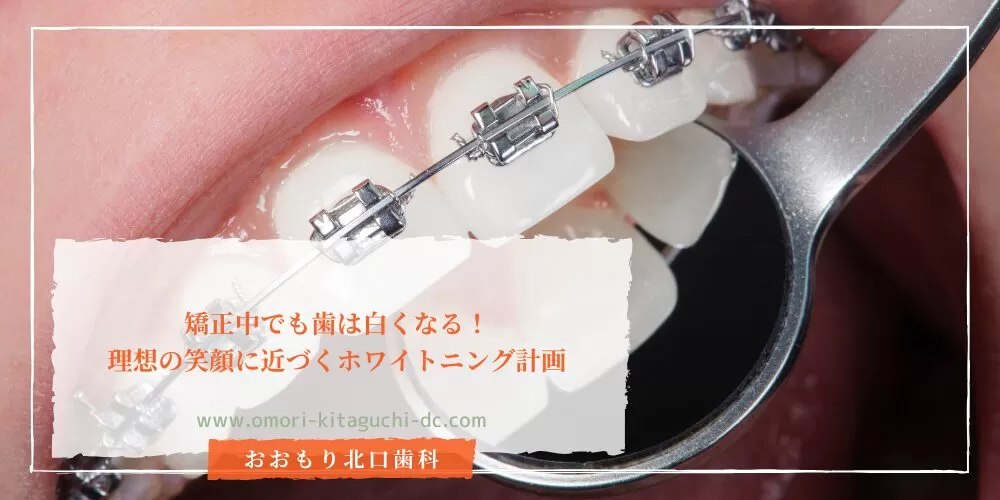 矯正中でも歯は白くなる!理想の笑顔に近づくホワイトニング計画