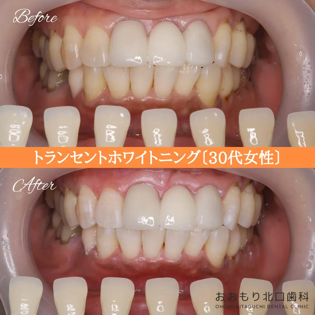 症例紹介99トランセントホワイトニング(30代女性) img