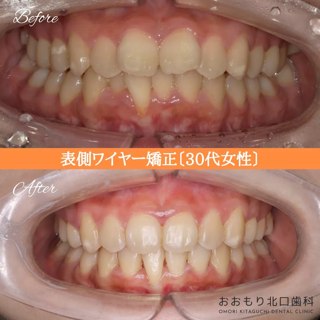 症例紹介⑮表側ワイヤー矯正(30代女性) img