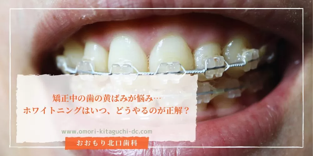 矯正中の歯の黄ばみが悩み…ホワイトニングはいつ、どうやるのが正解?