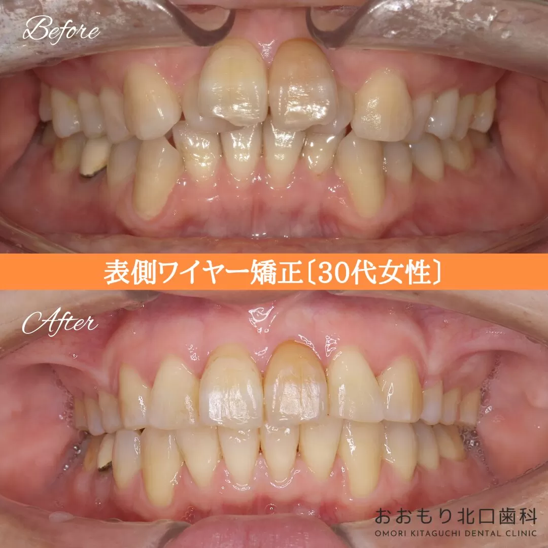 症例紹介⑰表側ワイヤー矯正（30代女性） img