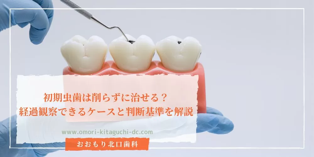初期虫歯は削らずに治せる?経過観察できるケースと判断基準を解説