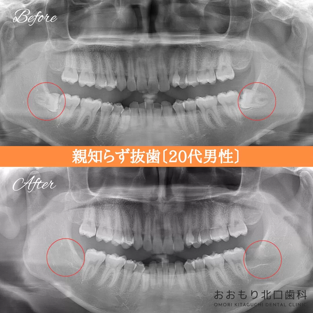 症例紹介㊺親知らず抜歯（20代男性） img