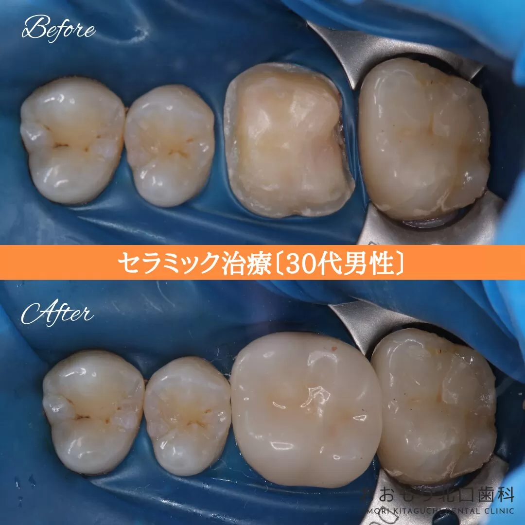 症例⑯ セラミック治療 30代男性 img